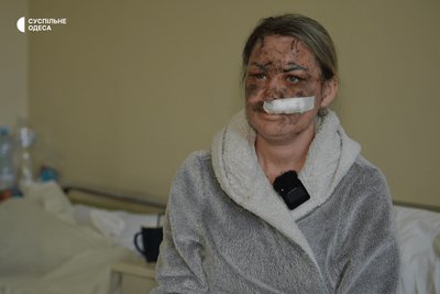Втратила вісім зубів і дістала поранення: одеситка розповіла про наслідки атаки РФ 28 вересня Втратила вісім зубів і дістала поранення: одеситка розповіла про наслідки атаки РФ 28 вересня