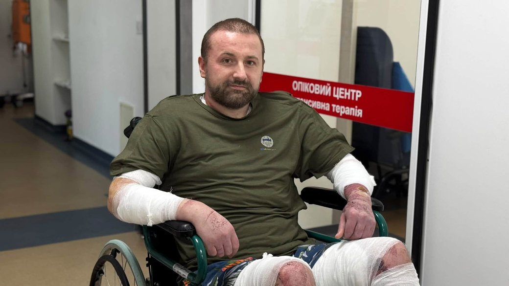 У Львові чоловік вижив після вибуху бойлера, попри опіки 80% тіла: лікарі рятували його шкірою свині та риби