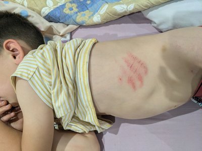 Дістав забій грудної клітини. У Кривому Розі дитина впала в каналізаційний люк