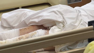 Три години провела під завалами. У лікарні Дніпропетровщини рятують поранених цивільних з Донеччини Три години провела під завалами. У лікарні Дніпропетровщини рятують поранених цивільних з Донеччини