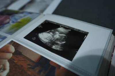 Сум’янка збирає гроші на операцію сину з ДЦП і сколіозом 4 ступеня Сум’янка збирає гроші на операцію сину з ДЦП і сколіозом 4 ступеня