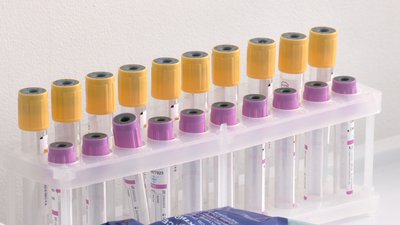 Катастрофічна потреба: чому на заготівлю крові у Черкасах потрібні тижні замість днів Катастрофічна потреба: чому на заготівлю крові у Черкасах потрібні тижні замість днів