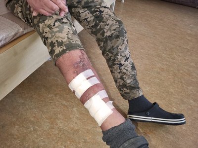 "Осколки просікли майже все тіло": історія волинянина, який підірвався на міні під Соледаром "Осколки просікли майже все тіло": історія волинянина, який підірвався на міні під Соледаром