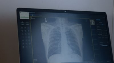 ШІ-рентген: у Черкасах діє мобільний флюорографічний кабінет ШІ-рентген: у Черкасах діє мобільний флюорографічний кабінет