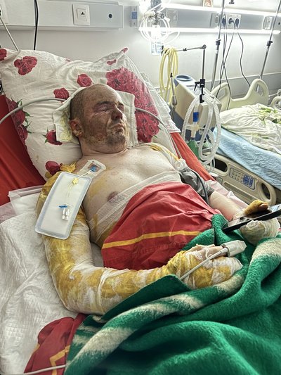 "Боялась дотиками зробити боляче". Чернівчанка Артенюк доглядає за хлопцем після того, як той отримав опіки на фронті "Боялась дотиками зробити боляче". Чернівчанка Артенюк доглядає за хлопцем після того, як той отримав опіки на фронті