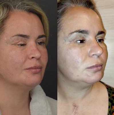 "На шляху до моєї великої краси": в Одесі безкоштовно видаляють травматичні татуювання "На шляху до моєї великої краси": в Одесі безкоштовно видаляють травматичні татуювання