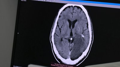 У Ковелі на Волині відкрили оновлений інсультний центр У Ковелі на Волині відкрили оновлений інсультний центр