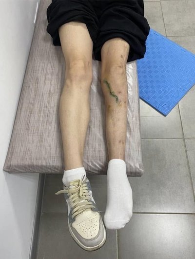 "Після двох операцій почала ходити": лікарі Рівненської обласної дитячої лікарні поставили на ноги 17-річну пацієнтку "Після двох операцій почала ходити": лікарі Рівненської обласної дитячої лікарні поставили на ноги 17-річну пацієнтку
