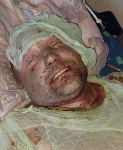 Військовий після поранення Військовий після поранення