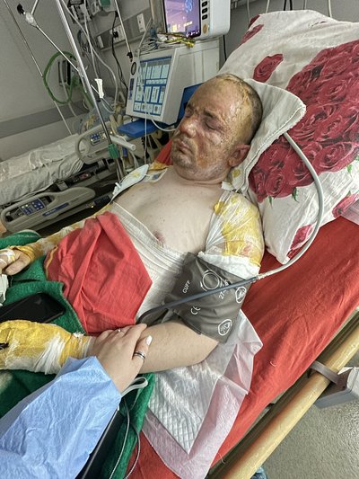 "Боялась дотиками зробити боляче". Чернівчанка Артенюк доглядає за хлопцем після того, як той отримав опіки на фронті "Боялась дотиками зробити боляче". Чернівчанка Артенюк доглядає за хлопцем після того, як той отримав опіки на фронті