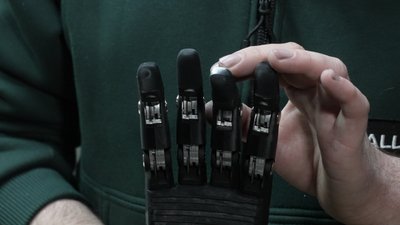 "Протезом навчився писати": що треба знати про біонічні протези та як їх виготовляють у Чернівцях "Протезом навчився писати": що треба знати про біонічні протези та як їх виготовляють у Чернівцях