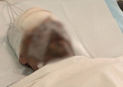 "Немає пальців, але життя врятоване". На Дніпропетровщині лікують двох військових із Донецького напрямку "Немає пальців, але життя врятоване". На Дніпропетровщині лікують двох військових із Донецького напрямку