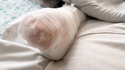 "Пробув на морозі дві доби": в обласній Кропивницького лікують перші випадки обмороження 2026 року "Пробув на морозі дві доби": в обласній Кропивницького лікують перші випадки обмороження 2026 року