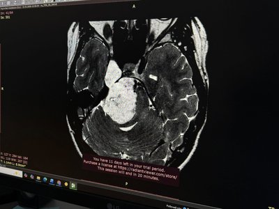 "Розуміла, що потрібно шукати вихід": у Львові видалили рідкісну пухлину мозку 25-річній дівчині "Розуміла, що потрібно шукати вихід": у Львові видалили рідкісну пухлину мозку 25-річній дівчині