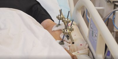 Отямився вже в реанімації. У медзакладі Дніпропетровщини лікують бійця, який потрапив під атаку дронів Отямився вже в реанімації. У медзакладі Дніпропетровщини лікують бійця, який потрапив під атаку дронів
