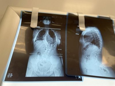 Вилікували сколіоз 4 ступеня: у Львові підлітку провели операцію на хребті Вилікували сколіоз 4 ступеня: у Львові підлітку провели операцію на хребті