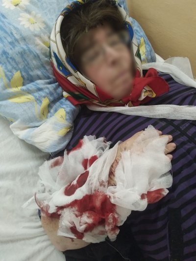 У місті на Житомирщині жінку покусав собака: постраждала знаходиться у лікарні У місті на Житомирщині жінку покусав собака: постраждала знаходиться у лікарні