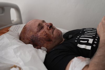 “Все сталося за мить”: що розповідають травмовані через атаку БпЛА в Сумах “Все сталося за мить”: що розповідають травмовані через атаку БпЛА в Сумах
