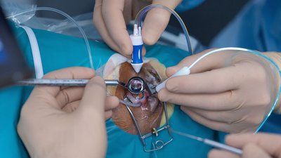 Відшарування сітківки ока: діагностика, операція та профілактика хвороби Відшарування сітківки ока: діагностика, операція та профілактика хвороби