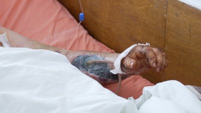 Втратив ногу через удар FPV-дрона: історія бійця, якого у вінницькому шпиталі готують до протезування Втратив ногу через удар FPV-дрона: історія бійця, якого у вінницькому шпиталі готують до протезування