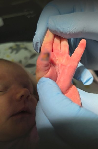 «Там немає пальця»: мати розповіла про травмування немовляти в одеській лікарні