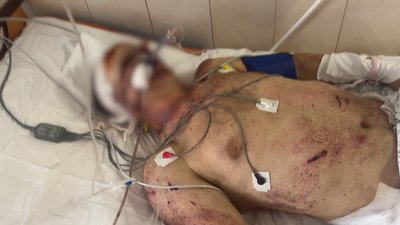 В реанімації після вибуху колеса: слюсар ЧТУ зазнав травм, ремонтуючи тролейбус В реанімації після вибуху колеса: слюсар ЧТУ зазнав травм, ремонтуючи тролейбус