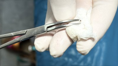 Як краще видалити кліща та чим вони небезпечні: роз’яснення від медиків з Полтавщини Як краще видалити кліща та чим вони небезпечні: роз’яснення від медиків з Полтавщини