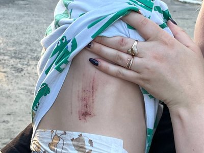 Пробита голова, садна та забій грудної клітини. У Дніпрі дворічний хлопчик провалився в триметровий люк у дворі Пробита голова, садна та забій грудної клітини. У Дніпрі дворічний хлопчик провалився в триметровий люк у дворі
