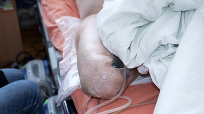 Втратив ногу через удар FPV-дрона: історія бійця, якого у вінницькому шпиталі готують до протезування Втратив ногу через удар FPV-дрона: історія бійця, якого у вінницькому шпиталі готують до протезування