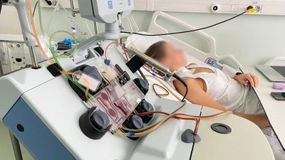 86 пересадок на рік: чому черкаська трансплантологія посіла друге місце в Україні 86 пересадок на рік: чому черкаська трансплантологія посіла друге місце в Україні