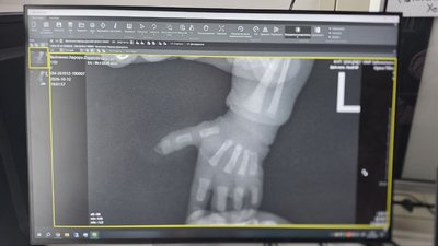«Там немає пальця»: мати розповіла про травмування немовляти в одеській лікарні