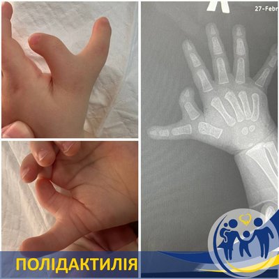 У Запоріжжі лікарі видалили дитині зайвий палець на руці У Запоріжжі лікарі видалили дитині зайвий палець на руці