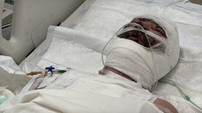 "Я чув голоси побратимів": на Дніпропетровщині лікують бійця, який пережив підрив на міні під Покровськом