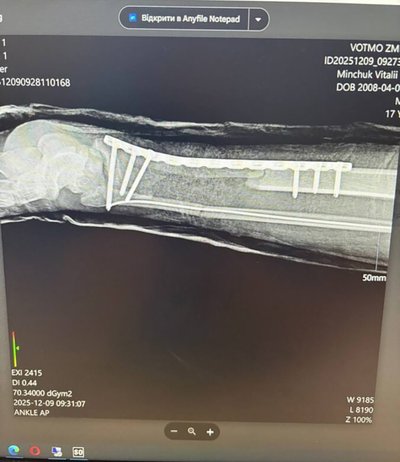 На Волині лікарі врятували ногу неповнолітньому мотоциклісту На Волині лікарі врятували ногу неповнолітньому мотоциклісту