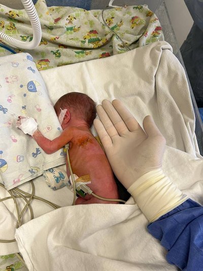 В Одесі прооперували немовля із вродженою вадою серця В Одесі прооперували немовля із вродженою вадою серця