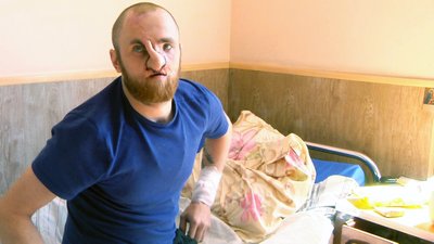 Команда хірургів відновлює обличчя й ніс після поранення військовому з Волині Команда хірургів відновлює обличчя й ніс після поранення військовому з Волині