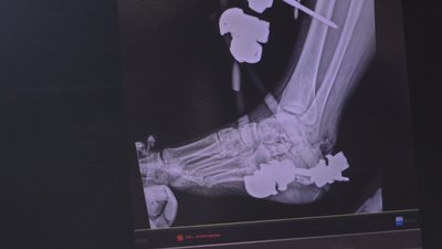 На Дніпропетровщині лікують поранену працівницю підприємства у Дніпрі, по якому вдарили ракетою 10 квітня На Дніпропетровщині лікують поранену працівницю підприємства у Дніпрі, по якому вдарили ракетою 10 квітня