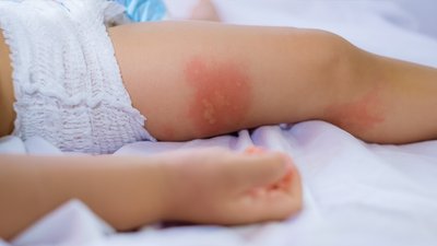 Щонайменше у 90 дітей на Чернігівщині щороку виявляють алергію на молоко: в чому причина та чи є альтернатива продукту Щонайменше у 90 дітей на Чернігівщині щороку виявляють алергію на молоко: в чому причина та чи є альтернатива продукту