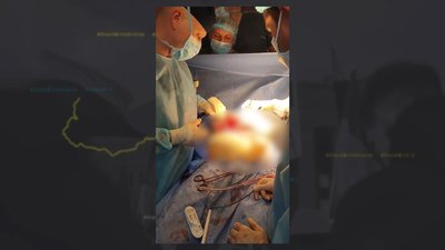 У Житомирі вперше провели одночасну трансплантацію трьох органів – донором став 31-річний чоловік У Житомирі вперше провели одночасну трансплантацію трьох органів – донором став 31-річний чоловік