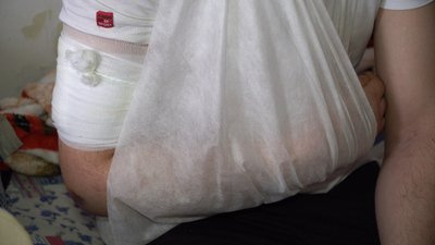"Відчуваю уламок у руці". У Дніпрі лікується військовослужбовець Дмитро "Відчуваю уламок у руці". У Дніпрі лікується військовослужбовець Дмитро