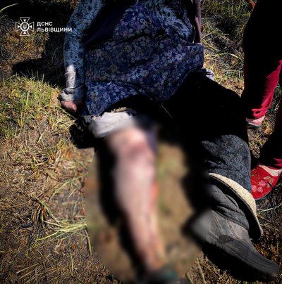 Жінка отримала опіки ноги Жінка отримала опіки ноги