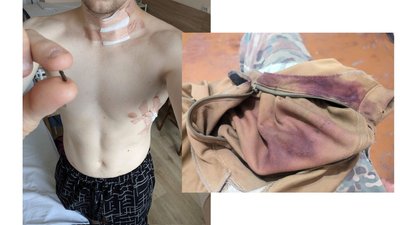 поранення асєєва поранення асєєва