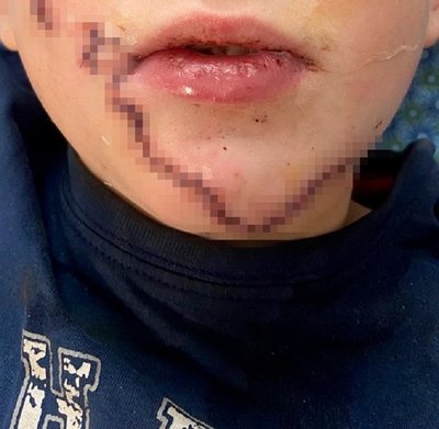 У Львові прооперували 10-річного хлопчика після складної травми обличчя під час катання на санках У Львові прооперували 10-річного хлопчика після складної травми обличчя під час катання на санках