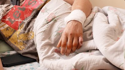 "Пробув на морозі дві доби": в обласній Кропивницького лікують перші випадки обмороження 2026 року "Пробув на морозі дві доби": в обласній Кропивницького лікують перші випадки обмороження 2026 року