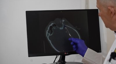 Черепно-мозкова травма та вибите око. На Дніпропетровщині лікують пораненого жителя Донеччини Черепно-мозкова травма та вибите око. На Дніпропетровщині лікують пораненого жителя Донеччини