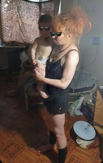 "Врятували з наркопритону": в Одесі вилучили дитину з ранами від вошей "Врятували з наркопритону": в Одесі вилучили дитину з ранами від вошей