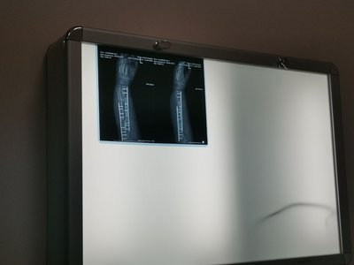 УПолтаві лікарі вживили в руку 3Д імплант УПолтаві лікарі вживили в руку 3Д імплант