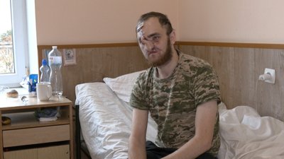 Команда хірургів відновлює обличчя після поранення військовому з Волині Команда хірургів відновлює обличчя після поранення військовому з Волині