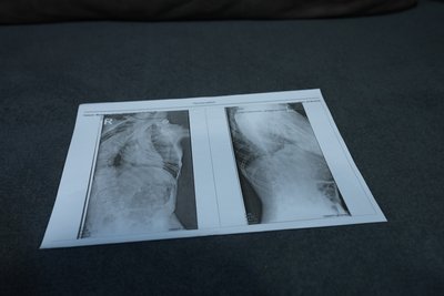 Сум’янка збирає гроші на операцію сину з ДЦП і сколіозом 4 ступеня Сум’янка збирає гроші на операцію сину з ДЦП і сколіозом 4 ступеня