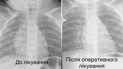 Пів року кашлю та задишки: у дівчинки зі Львівщини у дихальних шляхах знайшли шматок пластику Пів року кашлю та задишки: у дівчинки зі Львівщини у дихальних шляхах знайшли шматок пластику